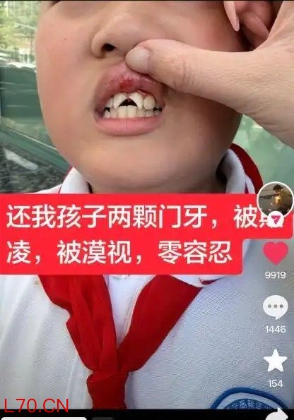 山东9岁男孩在托管机构磕断2颗门牙，家长称老师未及时送医救治，律师解读